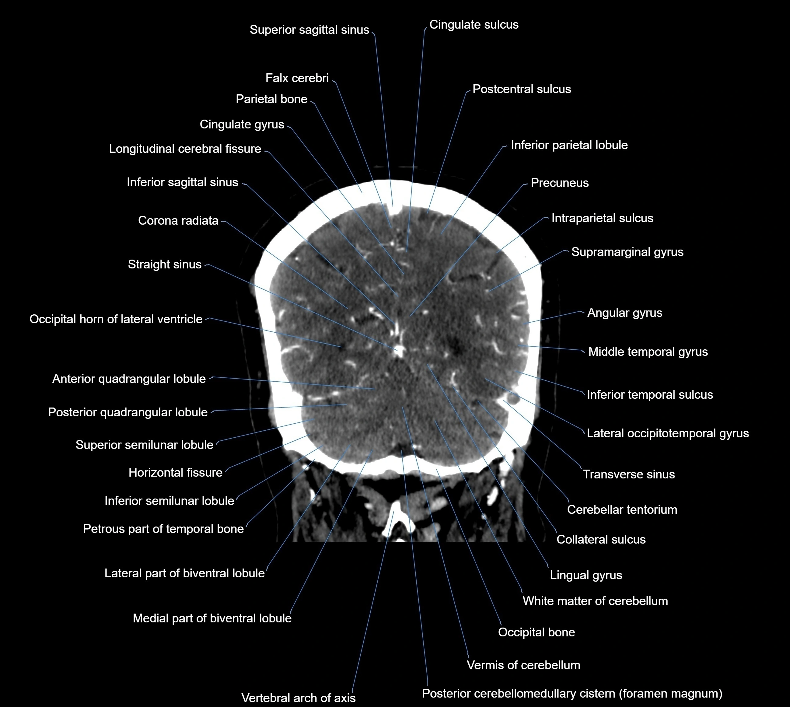 CT Brain coronal cross sectional radiology anatomy image  -img-00001-036.webp